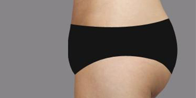 自體脂肪豐臀術(shù)后