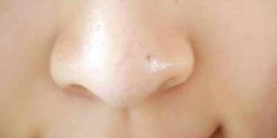 彩光嫩膚術(shù)后