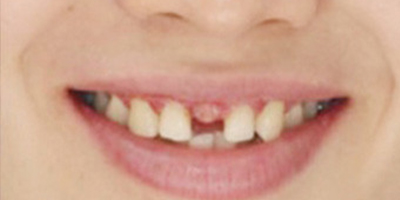 種植牙術(shù)前