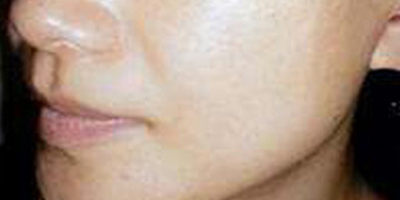 微針美塑術(shù)后