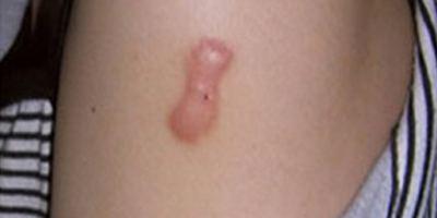 擴(kuò)張器祛疤術(shù)前