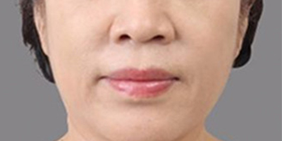 PRP美塑美膚術后