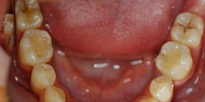 牙周護理術(shù)前