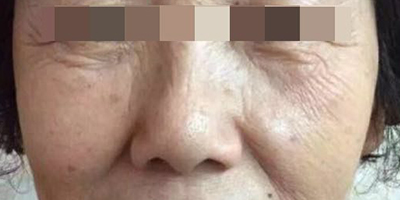 精華導(dǎo)入術(shù)前