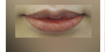 溶解酶術(shù)后