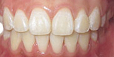 金屬托槽矯正術后