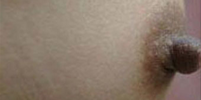 乳頭縮小術(shù)前