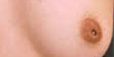 乳頭內陷矯正術前