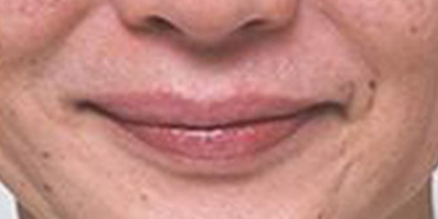 注射去口周紋術(shù)前