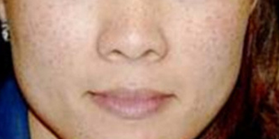 激光祛斑術(shù)前