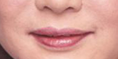 注射去口周紋術(shù)后