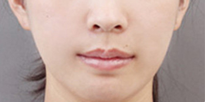 脂肪填充失敗修復術(shù)后