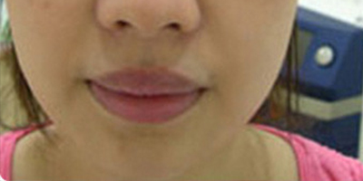 厚唇改薄術(shù)前