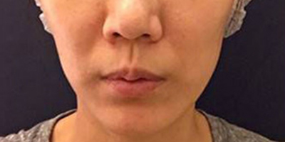 伊膚泉療程套組術(shù)前