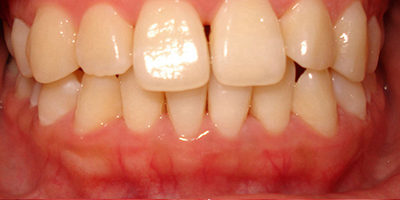 牙髓炎術(shù)前