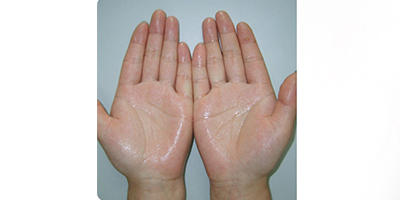 注射治療多汗術前