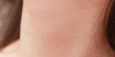 嗨體去頸紋術(shù)后