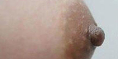 乳頭縮小術(shù)后