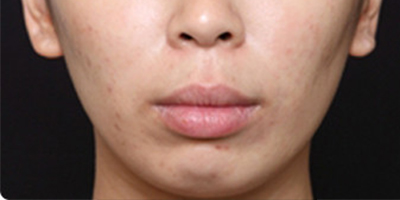 注射頦肌放松術(shù)前