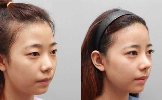 耳軟骨隆鼻的優(yōu)缺點是什么？肋軟骨隆鼻和耳軟骨隆鼻有什么區(qū)別？