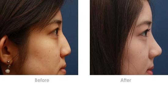 隆鼻假體取出后鼻子會(huì)不會(huì)變形？隆鼻假體取出后能不能恢復(fù)原樣？