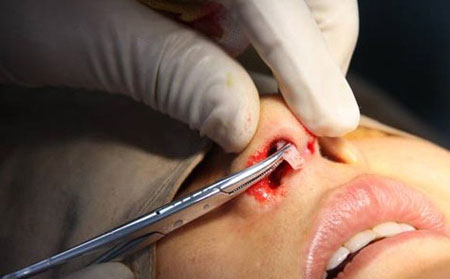 鼻子假體取出需要多少錢(qián)？取出后鼻子會(huì)恢復(fù)原來(lái)樣子嗎？