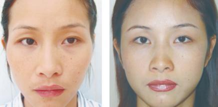 假體填充豐太陽(yáng)穴怎么做？假體豐太陽(yáng)穴的方法有哪些？