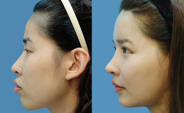 上下顎矯正術(shù)是什么手術(shù)?。肯骂M角骨骼大用什么方法去除？