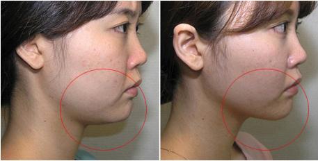 雙下巴吸脂多長時間恢復(fù)？雙下巴吸脂術(shù)能保持多久？