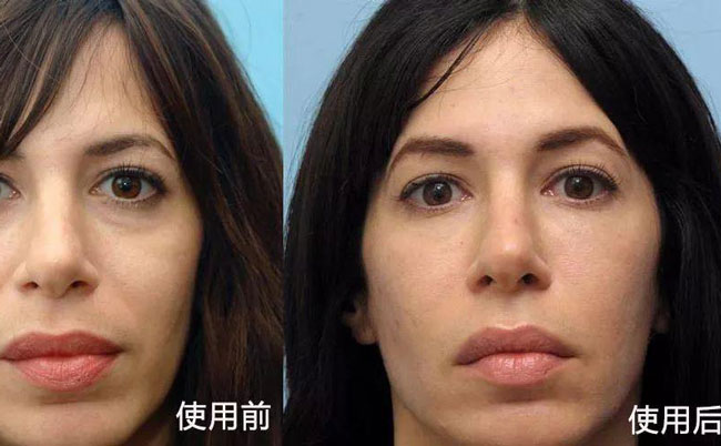 法令紋去除手術(shù)效果好嗎？法令紋怎么消除?最好的方法是什么？