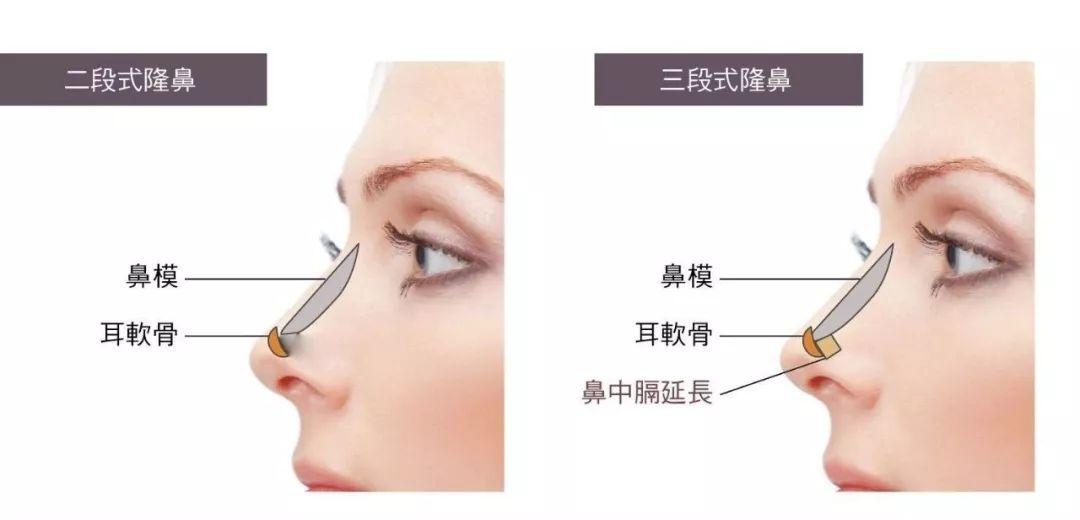 自體軟骨隆鼻的手術(shù)優(yōu)缺點(diǎn)有哪些?肋軟骨填充鼻基底多久能自然?