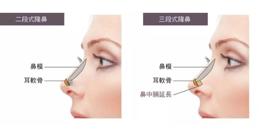 自體軟骨隆鼻的手術(shù)優(yōu)缺點(diǎn)有哪些？肋軟骨填充鼻基底多久能自然？