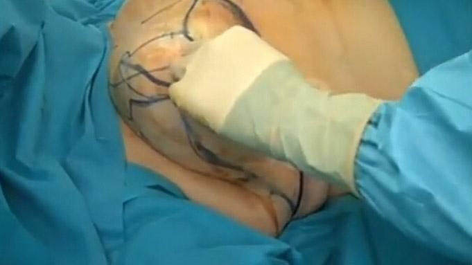 乳房縮小手術(shù)要多少錢(qián)？乳房縮小術(shù)是大手術(shù)嗎？