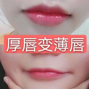 厚唇改薄整形手術(shù)價格？厚唇改薄多久完全恢復(fù)？