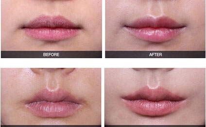 嘴角上揚術(shù)有幾種方法？嘴角上揚術(shù)疤痕恢復(fù)期？