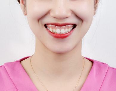 露齦笑能矯正嗎？肉毒素治療露齦笑注射量是多少？