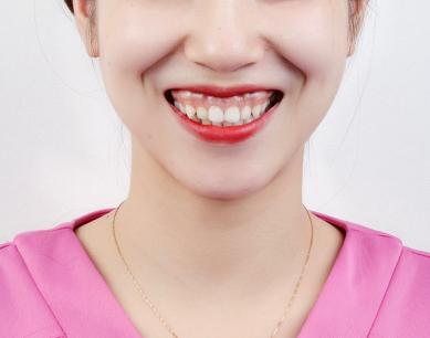 露齦笑能矯正嗎？肉毒素治療露齦笑注射量是多少？