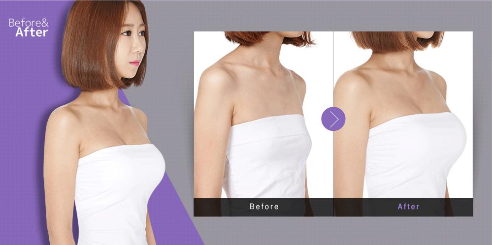 復(fù)合隆胸多少錢(qián)？復(fù)合隆胸后要注意什么？