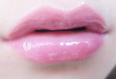 自體脂肪豐唇效果好嗎？自體脂肪豐唇大概多少錢(qián)？