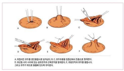 乳頭內(nèi)陷矯正手術(shù)多少錢？乳頭內(nèi)陷矯正手術(shù)多久可以恢復(fù)？