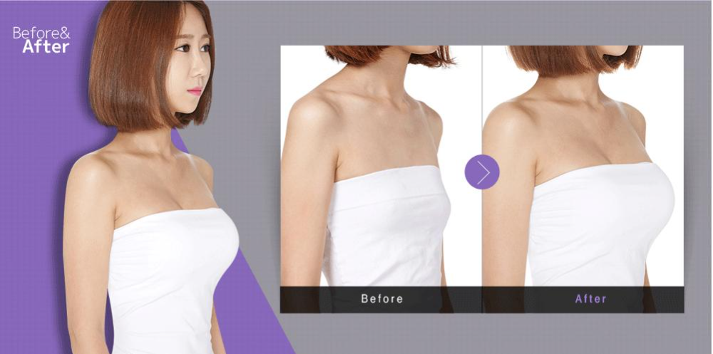 復(fù)合隆胸多少錢？復(fù)合隆胸后要注意什么？