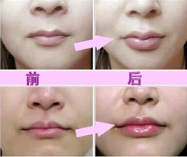 玻尿酸豐唇珠效果怎么樣？玻尿酸豐唇珠多少錢？