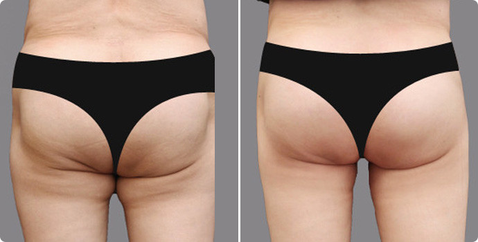 吸脂瘦臀部價格多少？吸脂瘦臀術(shù)后如何護理？
