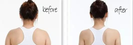 后背抽脂那些人可以做？吸脂瘦肩膀多少錢？