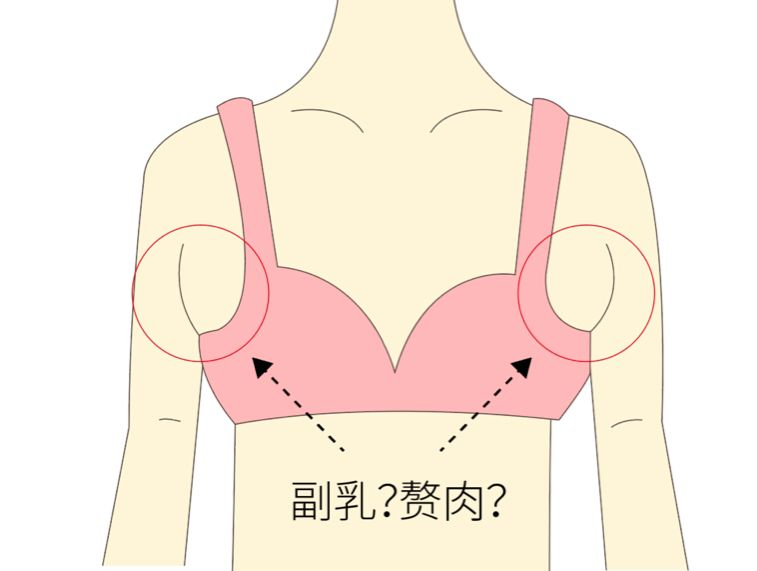 手術(shù)去副乳效果怎么樣？手術(shù)去副乳要注意什么？