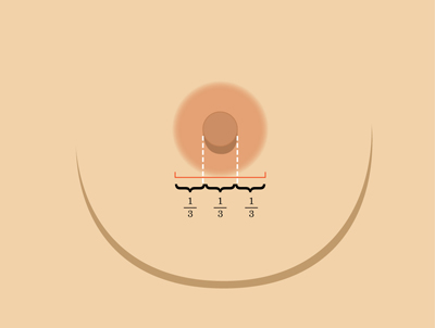 乳暈縮小如何矯正 乳暈縮小術(shù)的注意事項有哪些？