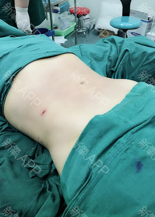 腰腹抽脂效果怎么樣？腰腹抽脂沒有瘦的原因？