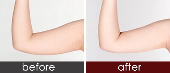 手臂抽脂效果明顯嗎 ？吸脂瘦手臂會(huì)反彈嗎？