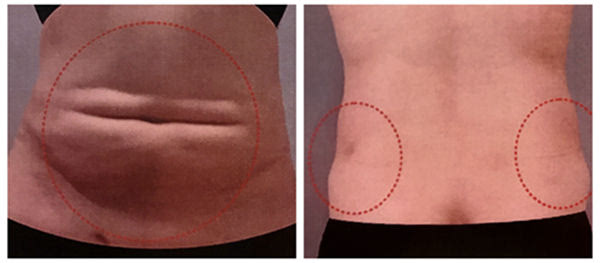 吸脂失敗了多久可以修復？吸脂失敗修復怎么解決？