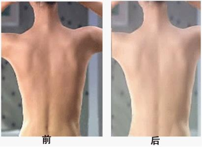 背部吸脂多久恢復(fù)？吸脂瘦背部注意事項